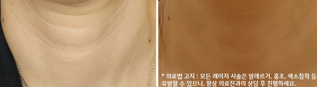 유스앤영서울뷰의원 목주름/손등 목주름 치료 전후 사진