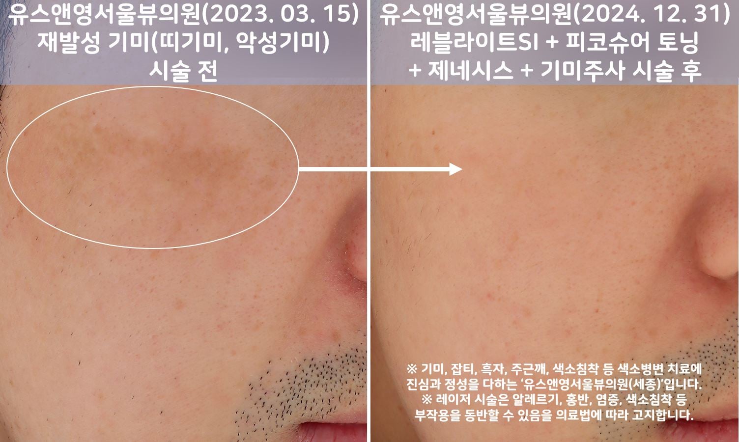 유스앤영서울뷰의원 기미/잡티/색소 전후사진 01