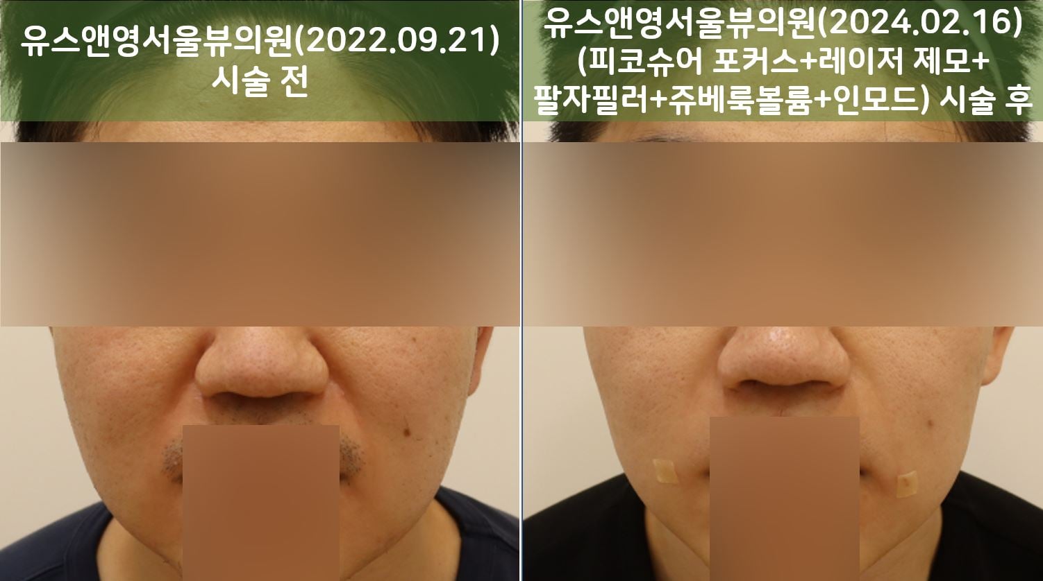 유스앤영서울뷰의원 쁘띠/리프팅 전후사진 01